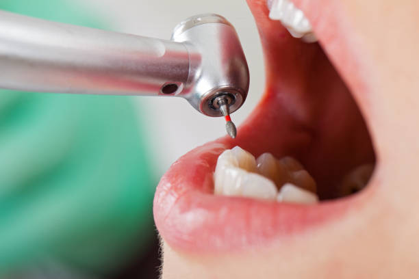 Best Emergency Dentist for Knocked-Out Tooth in Lake Linden, MI